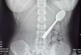 Đang ăn sữa chua, người phụ nữ nuốt chiếc thìa dài 17cm vào bụng