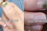 Người phụ nữ bị mốc móng tay sau khi làm nails, bác sĩ lên tiếng cảnh báo