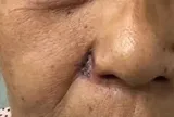 Tưởng nốt ruồi thông thường, người phụ nữ bị ung thư phá hủy toàn bộ cánh mũi