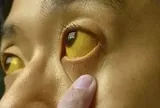 Nếu mắt có 6 thứ, đi khám ung thư ngay còn kịp!