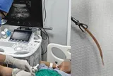 Đau bụng suốt 10 ngày, bất ngờ phát hiện tăm tre đâm thủng đại tràng