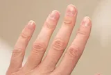 Kiểm tra móng tay ngay xem có dấu hiệu này không - nếu có phải đi khám!