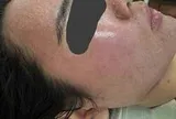 Mặt sưng phù, nổi kín mụn sau vài lần dùng mỹ phẩm dưỡng trắng trên mạng