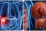 9 triệu chứng ung thư gan giai đoạn đầu