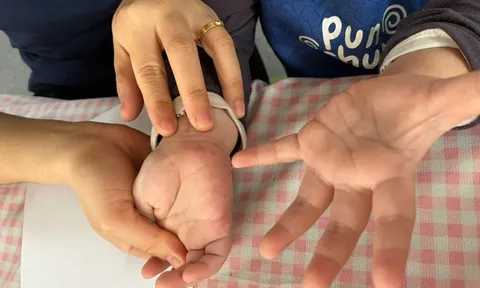 Tưởng con sốt phát ban, bà mẹ tá hỏa khi bác sĩ kết luận tay chân miệng