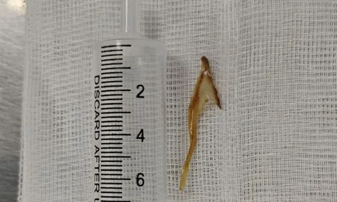 Tưởng bị trĩ hóa ra xương gà dài 3cm mắc ở hậu môn 0