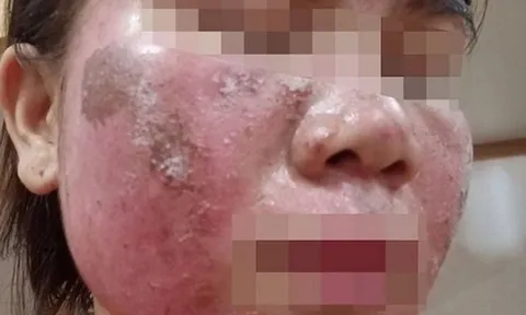 'Vỡ mộng' da đẹp đón Tết: Tan nát mặt vì tự peel da theo hướng dẫn trên mạng 1