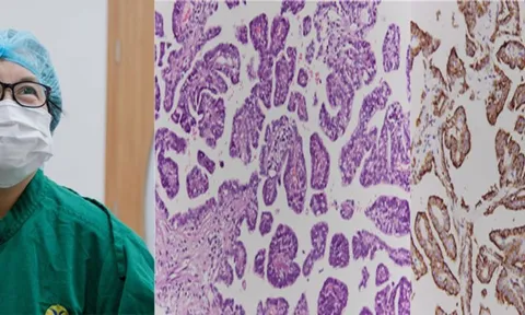 Đi khám viêm dạ dày, phát hiện ung thư phổi hiếm gặp 0