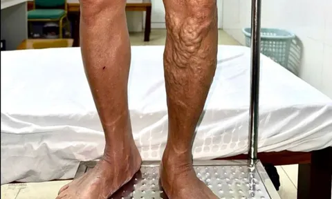 Chân bỗng nổi 'sợi dây thừng' ngoằn ngoèo vì đứng lâu, đi lại nhiều 0