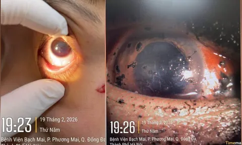 Bệnh viện Bạch Mai cảnh báo 1 tình trạng bệnh ở mắt tăng vọt ngay trong 3 ngày đầu năm 2026