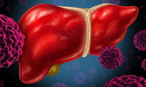 Phát hiện 'thủ phạm' âm thầm 'nuôi' tế bào ung thư trong gan: Không phải rượu bia hay thuốc lá