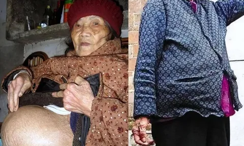 Cụ bà 91 tuổi ngã khi đi lấy nước, vào viện thì phát hiện “mang thai”: Bí mật về "bào thai hoá đá"