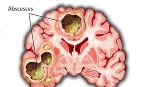 Phát hiện áp xe não nguy hiểm sau 2 tuần đau đầu, buồn ngủ triền miên