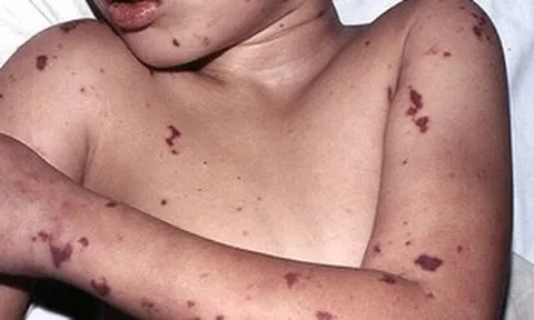 Cảnh báo bệnh não mô cầu ở trẻ: Dễ nhầm cảm cúm, nguy cơ tử vong cao