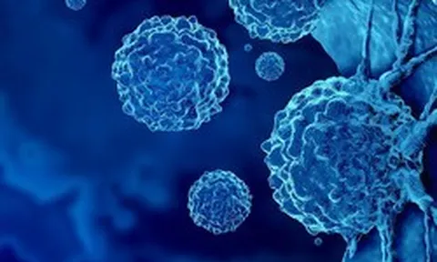 Loại ung thư đứng thứ 2 về tỉ lệ tử vong tại Việt Nam: 5 dấu hiệu sớm nhất ai cũng nên biết