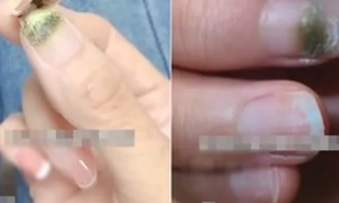 Người phụ nữ bị mốc móng tay sau khi làm nails, bác sĩ lên tiếng cảnh báo