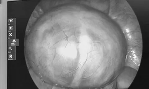 Đau bụng tưởng nhẹ, người phụ nữ sốc nặng khi bác sĩ lấy ra thứ “rợn người” trong cơ thể