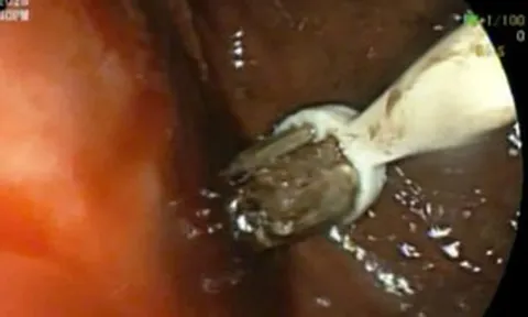 Nam thanh niên 29 tuổi đau bụng, bác sĩ lấy ra thứ "đáng sợ" trong cơ thể