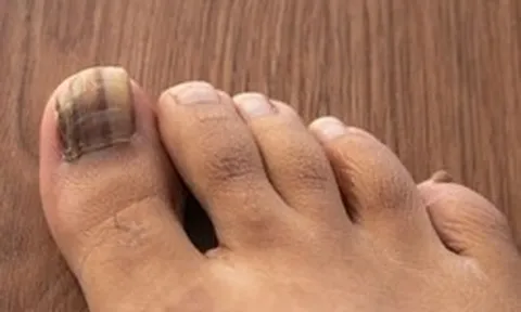 Dấu hiệu ở móng chân cảnh báo loại ung thư nguy hiểm: Nhiều người bỏ qua, bác sĩ khẩn thiết nhắc nhở