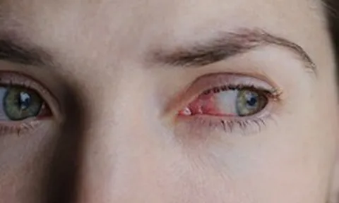 Chàng trai 24 tuổi mù đột ngột: Bác sĩ cảnh báo về thói quen mà nhiều người trẻ đang mắc mỗi tuần