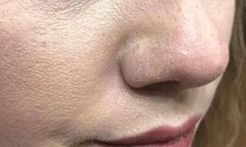 Vì sao thoa kem chống nắng bị mốc trắng, xử lý thế nào?