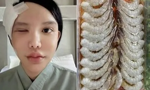Người phụ nữ bị ký sinh trùng bò vào hốc mắt, suýt mù, bác sĩ cảnh báo 1 thói quen nhiều người Việt mắc phải