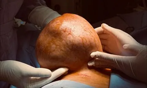 Mang "quả tạ" gần 4kg suốt nhiều năm, người phụ nữ bàng hoàng khi biết sự thật