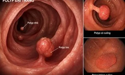 3 thực phẩm quen thuộc, dễ tìm có thể ngăn ngừa polyp đại tràng, nhiều gia đình Việt có sẵn trong bếp