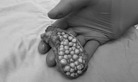 Đau bụng suốt 1 tháng, người phụ nữ 38 tuổi sốc khi bác sĩ lấy ra thứ "đáng sợ" trong bụng