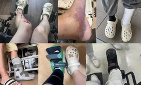 Lời khuyên cho những người thích đi dép sục, dép "kiểu crocs"
