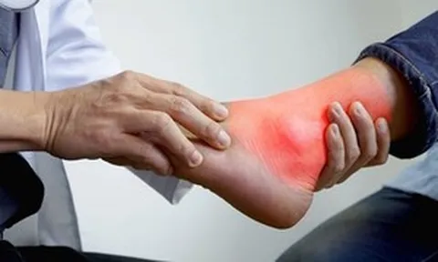 Chủ quan với đau khớp chân, thanh niên 20 tuổi ngỡ ngàng khi phát hiện mắc gout