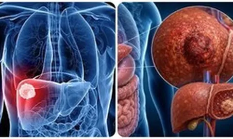 9 triệu chứng ung thư gan giai đoạn đầu