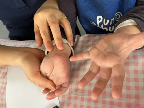 Tưởng con sốt phát ban, bà mẹ tá hỏa khi bác sĩ kết luận tay chân miệng