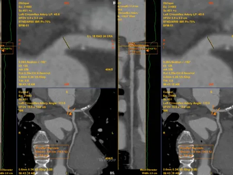 Chỉ đau tức ngực trái thoáng qua, không ngờ phát hiện bệnh lý tim mạch nguy hiểm 0