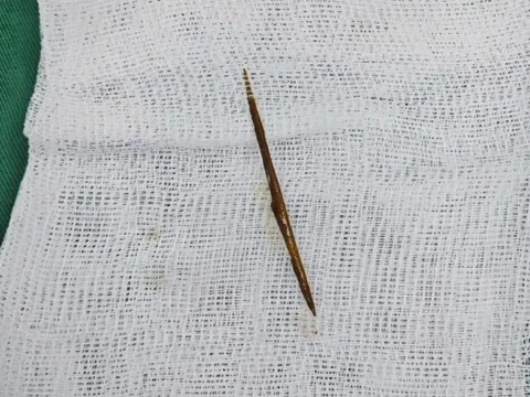 Thủng ruột vì thói quen ngậm tăm sau ăn nhiều người mắc 0