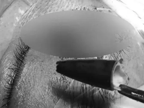 Người đàn ông đau mắt dữ dội, bác sĩ lấy ra thứ "đáng sợ"