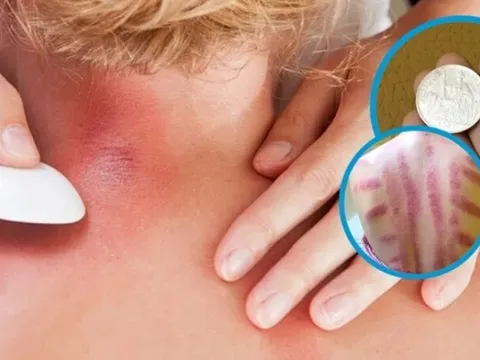 Vì sao đau mỏi người, 'trúng gió' dùng đồ bạc, trứng gà để cạo gió? 0