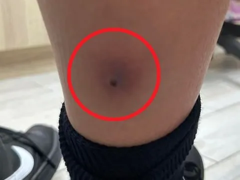 Tưởng chỉ là cúm mùa, bé trai 12 tuổi sốt trở lại: Bác sĩ vén ống quần kiểm tra liền yêu cầu cấp cứu khẩn cấp