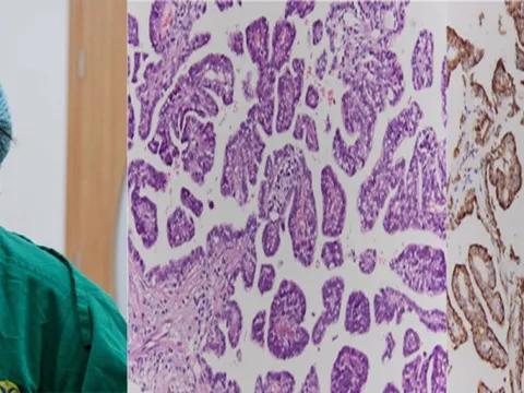 Đi khám viêm dạ dày, phát hiện ung thư phổi hiếm gặp 0