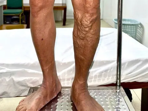 Chân bỗng nổi 'sợi dây thừng' ngoằn ngoèo vì đứng lâu, đi lại nhiều 0