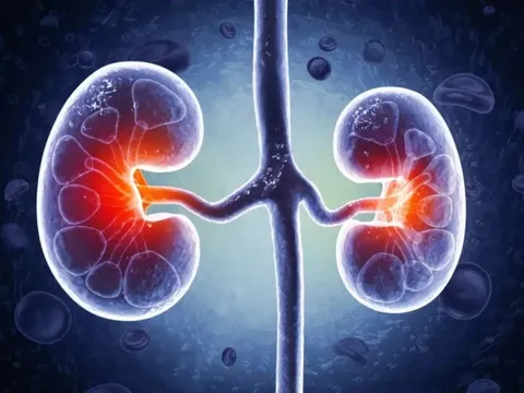 1 thói quen “bức tử” 2 quả thận: Rất nhiều người đang làm mỗi ngày