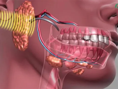 U xương hàm là bệnh gì? Dấu hiệu nhận biết sớm nhiều người dễ bỏ qua 0