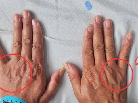 Tê ngón tay út tưởng chuyện nhỏ, người đàn ông 51 tuổi suýt bị teo cả bàn tay