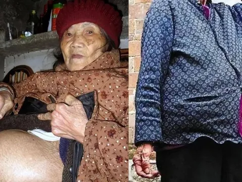 Cụ bà 91 tuổi ngã khi đi lấy nước, vào viện thì phát hiện “mang thai”: Bí mật về "bào thai hoá đá"