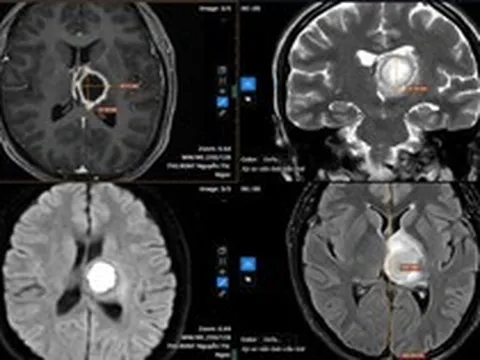 Thường xuyên buồn ngủ, đi khám “sốc” nặng khi biết nguyên nhân