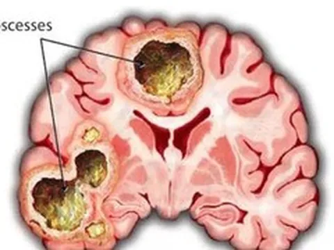 Phát hiện áp xe não nguy hiểm sau 2 tuần đau đầu, buồn ngủ triền miên