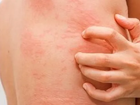 Thấy vàng da kèm ngứa, người phụ nữ đi khám phát hiện mắc 2 loại ung thư: Bệnh viện Bạch Mai nói quá hiếm gặp, thách thức trong chẩn đoán