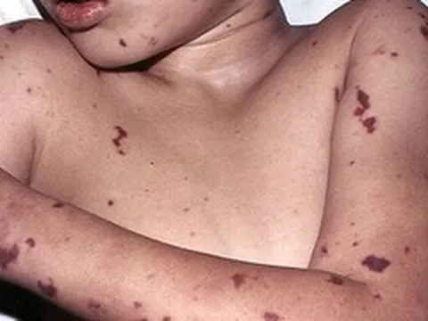 Cảnh báo bệnh não mô cầu ở trẻ: Dễ nhầm cảm cúm, nguy cơ tử vong cao