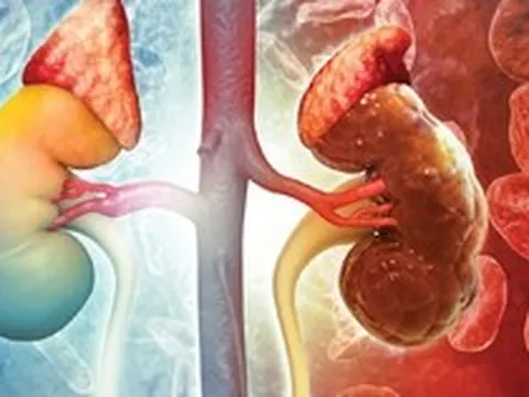 Suy thận có thể tấn công bất ngờ không báo trước: Đây là 4 đối tượng cần đặc biệt cảnh giác