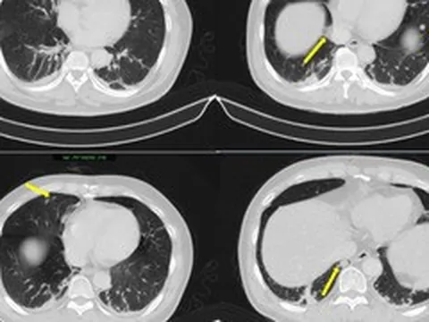 Người đàn ông phát hiện mắc hai bệnh ung thư cùng lúc
